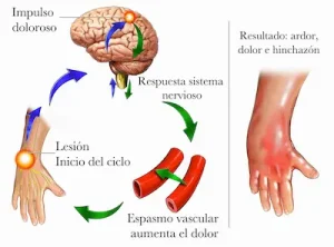 Esquema de tratamiento y rehabilitación del síndrome de Sudeck