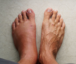 Esquema de tratamiento y rehabilitación del síndrome de Sudeck