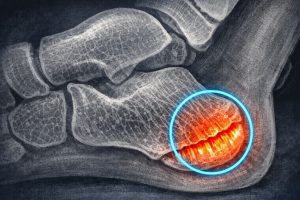 Dolor de talón en niños y adolescentes (Enfermedad de Sever)