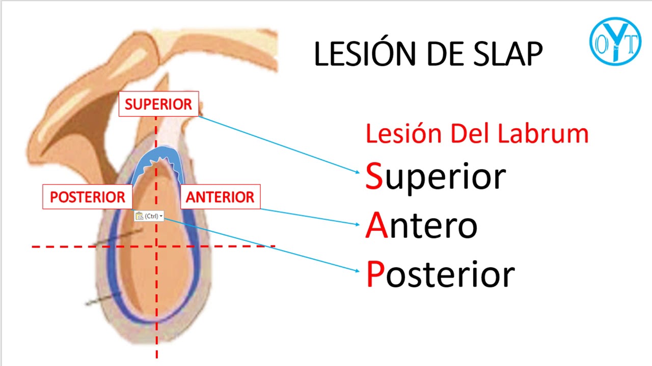 Resonancia magnética y diagnóstico de lesión SLAP