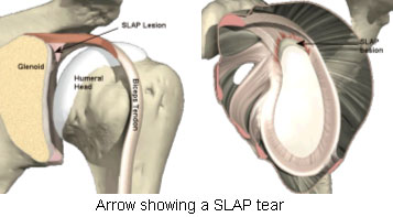 Cirugía artroscópica en lesión SLAP: reparación del labrum y manejo del bíceps