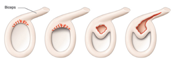 Tipos de lesión SLAP en el hombro