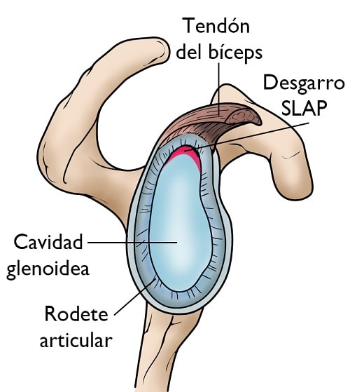 Mecanismos típicos de lesión SLAP: caída, tracción o gesto repetido por encima de la cabeza