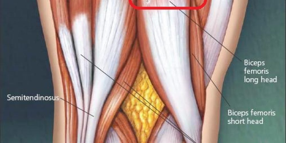 Rotura del bíceps femoral