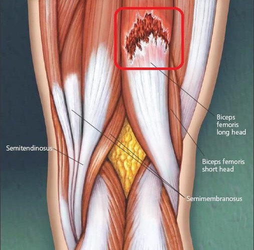 Rotura del bíceps femoral