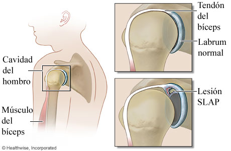 Anatomía del labrum y bíceps en el hombro (lesión SLAP)